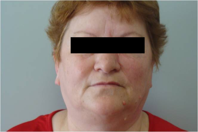 Basal cell carcinoma of the left cheek - after a year